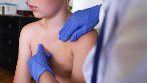Healthcare worker wearing blue gloves examines a child’s chest rash, showing early measles symptoms during a growing measles outbreak in the United States.