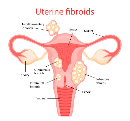 “Diagram showing uterine fibroids and increased heart disease risk in women.”